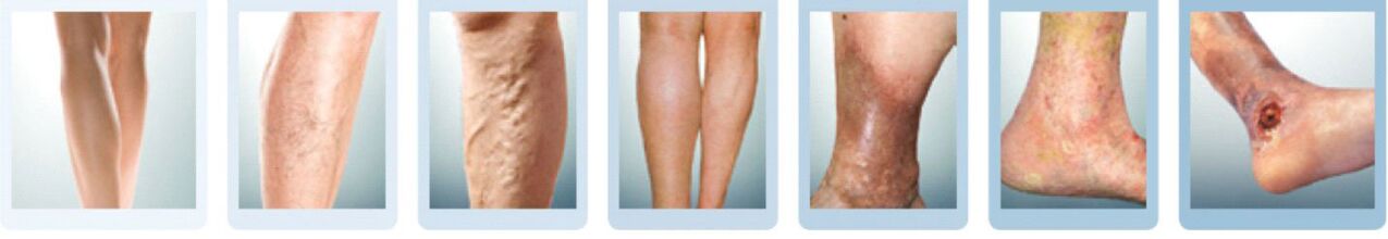 stades de développement des varices des jambes