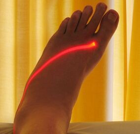 traitement au laser des varices sur les jambes