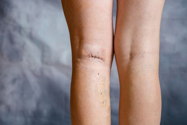 couture sur la jambe après chirurgie des varices