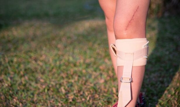 restauration des jambes après chirurgie des varices
