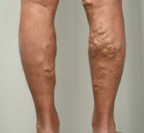 nœuds sur les jambes avec des varices