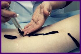 La procédure de traitement des varices avec des sangsues (hirudothérapie)