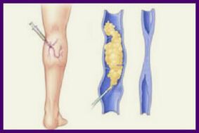 La sclérothérapie est une méthode populaire pour se débarrasser des varices sur les jambes