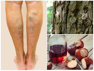 traitement des varices sur les jambes des remèdes populaires