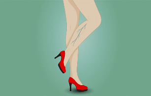 Varices sur les jambes d'une femme