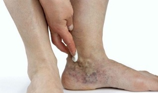 manifestations de varices sur les jambes