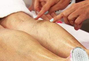 les varicosités des jambes chez les femmes