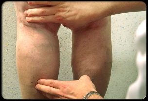 Médecin examine les jambes avec des varices