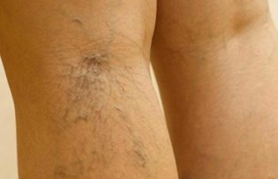 le traitement de varices sur les jambes