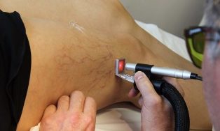 traitement des varices par laser