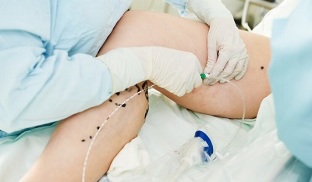méthodes de traitement des varices sur les jambes chez les femmes