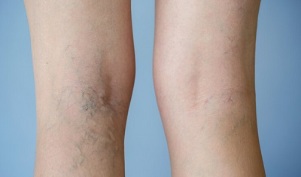 signes de varices dans les jambes chez les femmes