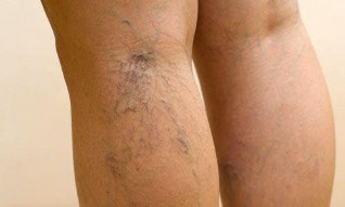 les varicosités des jambes