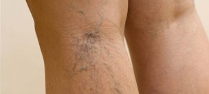 Les varicosités sur les jambes